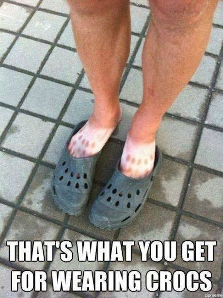 Meme: sunburned feet with polka-dot tan pattern from Crocs — 'That's what you get for wearing Crocs.'